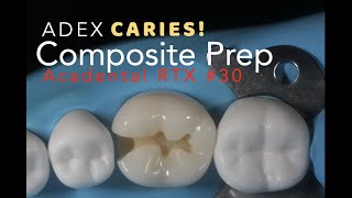 Class II Composite Preparation for ADEX Caries 30 MO [upl. by Gillead]