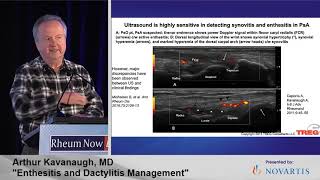 RNL 2021  Enthesitis amp Dactylitis Management Dr Arthur Kavanaugh [upl. by Richmound561]