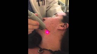 Fotona SP Dynamis Laser Treatment of Acne [upl. by Eegnat656]