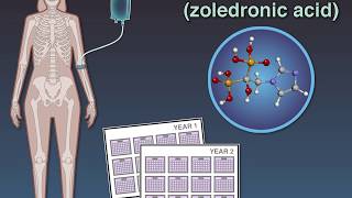 Zoledronate in Osteopenia [upl. by Erie130]