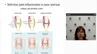 Diagnosing and managing psoriatic arthritis [upl. by Francesco]