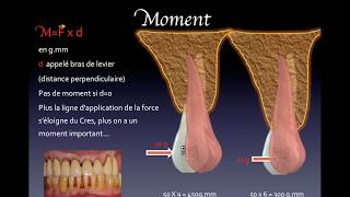 Biomécanique Orthodontique n°1 [upl. by Beedon]