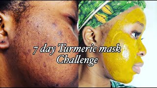 I TRIED TURMERIC MASK FOR 7DAYS  MY HONEST REVIEW  ACNE AND HYPERPIGMENTATION  Just Siphosami [upl. by Kevyn]