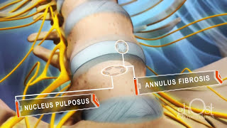 Herniated DISC Medical Animation  Ghost Medical Animation amp Surgical VR [upl. by Pallas870]