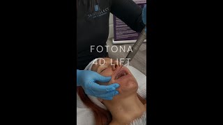 Fotona 4D Lift [upl. by Akem470]