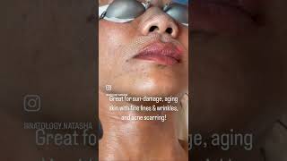 Fotona Micro Laser ResurfacingPeel [upl. by Arrakat612]