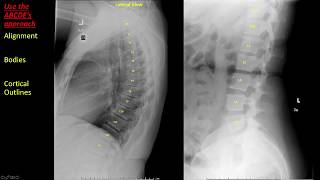 Introduction to Spine Radiographs [upl. by Andri]