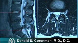 How to Read a MRI of a Lumbar Herniated Disc  Lower Back Pain  Colorado Spine Surgeon [upl. by Lodge]