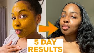 I DID A 5 DAY TURMERIC FACE MASK amp This Happened  MISS C Beauty [upl. by Nojad]