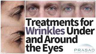 How to Treat Wrinkles Under and Around the Eyes [upl. by Edwyna]