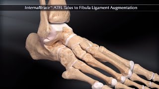 Dislocating Knee Cap Surgery  MPFL Reconstruction [upl. by Aniahs635]