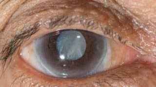 New eye drops may help treat cataracts [upl. by Jourdan114]