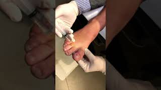 How to Perform a HBlock to Numb a Toe with Local Anaesthetic for Ingrown Nails [upl. by Chivers198]