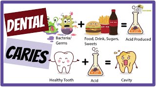 DENTAL CARIES Etiology Keyes Jordan diagram Stephans Curve SIMPLIFIED [upl. by Animlehliw]