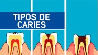 Tipos de caries  Odontoespecialistas [upl. by Gala683]