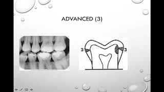 Interpretation of Dental Caries Source [upl. by Nyladnohr]