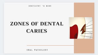 DENTAL CARIES ZONES [upl. by Inilam]