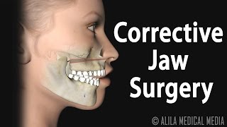 Corrective Jaw Orthognathic Surgery Animation [upl. by Bilac]