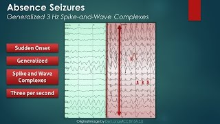 Absence Seizures EEG Findings [upl. by Naiditch]