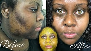 5 DAY TURMERIC FACE MASK CLEARED MY HYPERPIGMENTATION IM SHOOK [upl. by Abram]