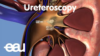 Your Lung Operation Your Discharge and Recovery [upl. by Tabbi392]