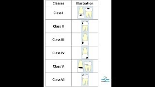 GVBLACKS CLASSIFICATION OF CARIES AND RESTORATIONS “gv black” [upl. by Asuncion821]