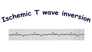 Mechanism of ischemic T wave inversion [upl. by Bonnie]