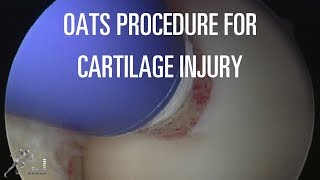 Cartilage Repair Basics  ACI  Denovo NT  Chondroplasty  Microfracture  Dr F [upl. by Westfall]