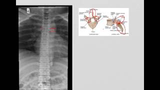 Thoracic Spine AP and Lateral [upl. by Strohben]