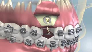 Impacted Tooth Exposure amp Uncovering For Orthodontics [upl. by Auhsuj906]