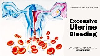 Excessive Uterine Bleeding  Jaypess Institute of Medical Science  Silchar [upl. by Tinya]